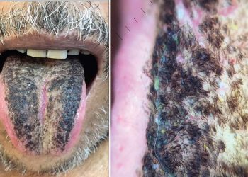 …پھر زبان پر اگ آئے کالے بال،حیران کرنے والا واقعہ