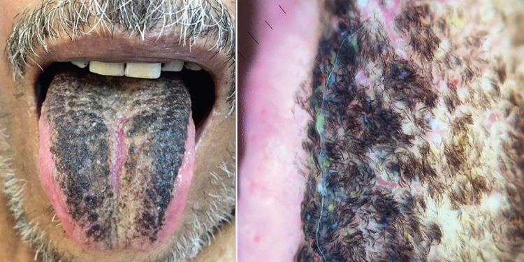 …پھر زبان پر اگ آئے کالے بال،حیران کرنے والا واقعہ